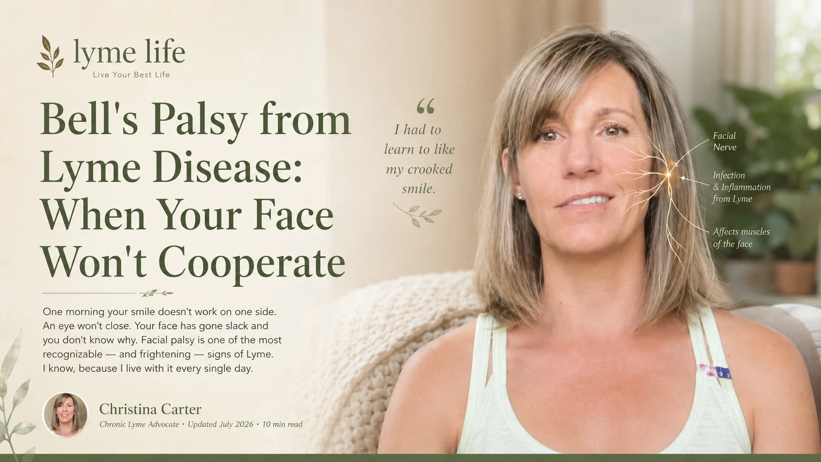 Bell's palsy facial paralysis from Lyme disease