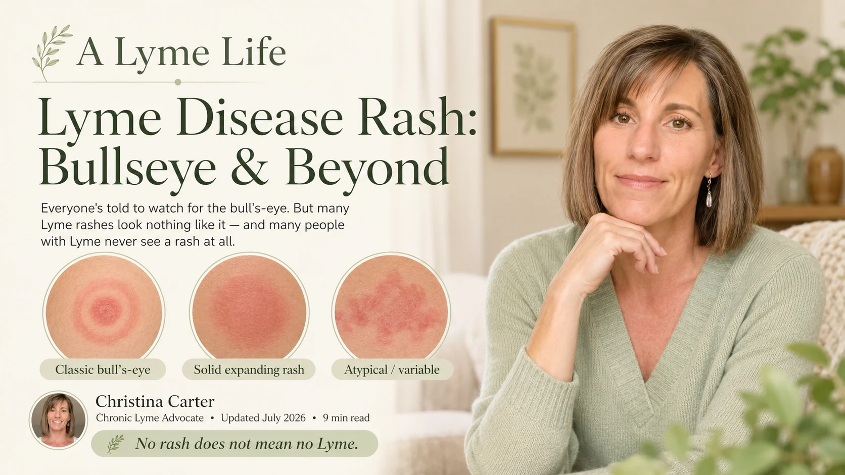 Lyme disease rash bullseye and atypical